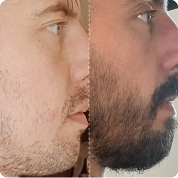 Callum’s story: From bare cheeks to a full beard
